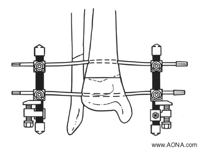 OSTEOTOMIES