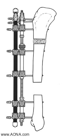 Rectilinear Bone Segment Transportation and Leg Strengthening