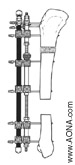 Rectilinear Bone Segment Transportation 
and Leg Strengthening