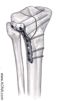 Proximal Tibia Plate Instrument and

 Implant Set