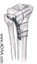 Proximal Tibia Plate