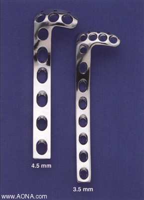 Proximal Tibia Plate Instrument and
 Implant Set