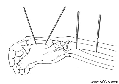 small external fixator