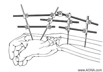 small external fixator