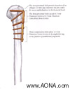 Titanium LC-Angle Blade Plate Instrument and Implant
 Set