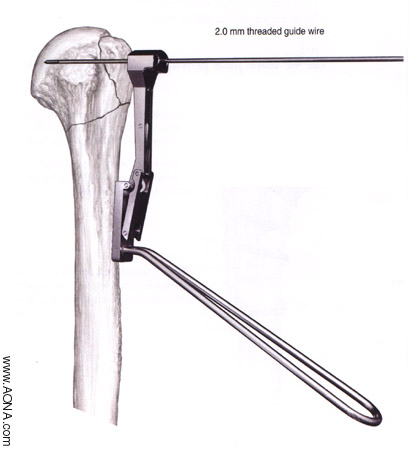 Titanium Cannulated LC-Angle Blade Plate Instrument and
 Implant Set