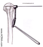 Titanium LC-Angle Blade Plate Instrument and Implant

 Set