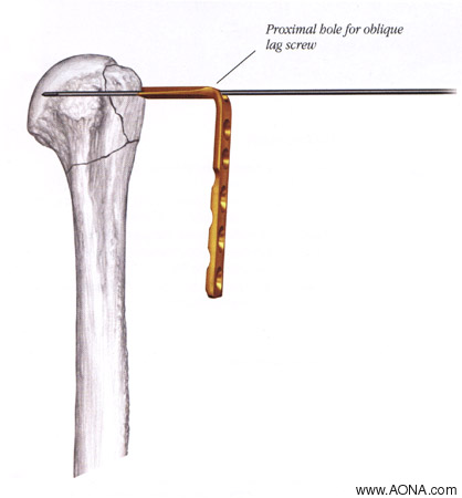 Titanium Cannulated LC-Angle Blade Plate Instrument and
 Implant Set