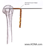 Titanium LC-Angle Blade Plate Instrument and Implant

 Set