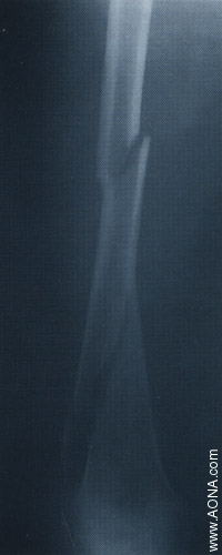 Titanium Distal Femoral Nail System