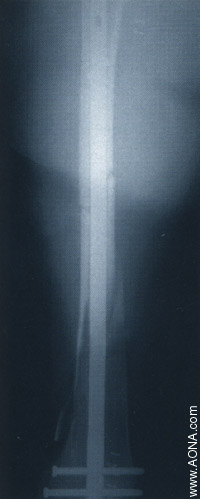 Titanium Distal Femoral Nail System