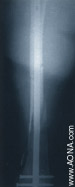 Titanium Distal Femoral Nail - Retrograde Insertion