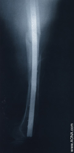 Titanium Distal Femoral Nail System