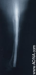 Titanium Distal Femoral Nail - Retrograde Insertion