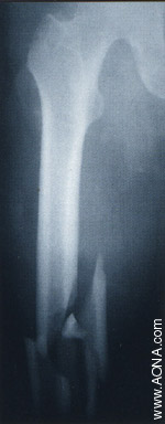 Titanium Distal Femoral Nail System