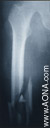 Titanium Distal Femoral Nail - Indications