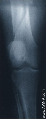 Titanium Distal Femoral Nail System