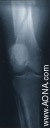 Titanium Femoral Distal Nail - Indications