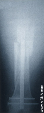 Titanium Distal Femoral Nail System