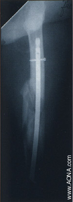 Titanium Distal Femoral Nail System