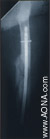 Titanium Femoral Distal Nail - Indications