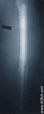 Titanium Distal Femoral Nail System