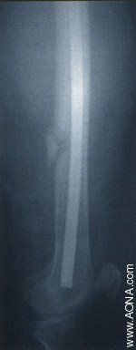 Titanium Distal Femoral Nail System