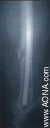 Titanium Distal Femoral Nail - Indications