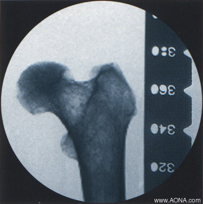 Titanium Distal Femoral Nail System