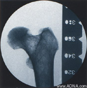 Titanium Distal Femoral Nail System