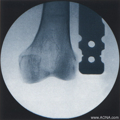 Titanium Distal Femoral Nail System