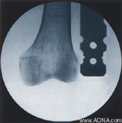 Titanium Distal Femoral Nail System