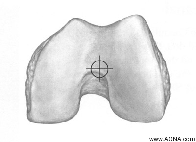 Titanium Distal Femoral Nail System