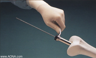 Titanium Distal Femoral Nail System