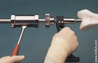 Titanium Distal Femoral Nail System