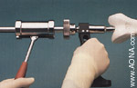 Titanium Distal Femoral Nail System