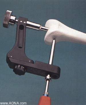 Titanium Distal Femoral Nail System