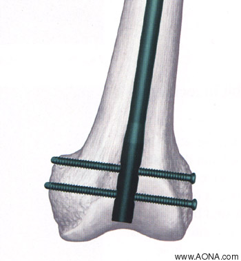 Titanium Distal Femoral Nail System