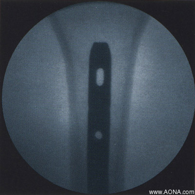 Titanium Distal Femoral Nail System