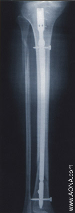 Titanium Tibial Nail System