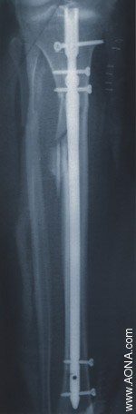 Titanium Tibial Nail System