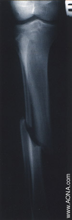 Diaphyseal Fracture