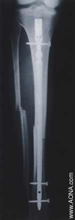 Diaphyseal Fracture