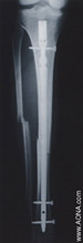 Diaphyseal fracture