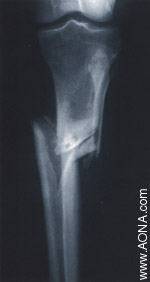 Diaphyseal Fracture