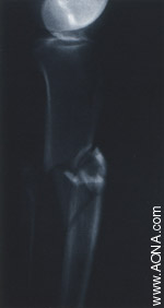 Diaphyseal Fracture