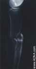 Fracture Involving Proximal Third Component