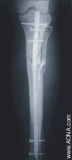 Diaphyseal Fracture