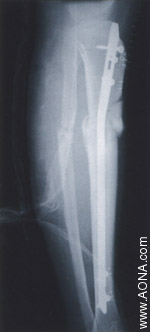 Diaphyseal Fracture