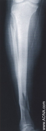 Distal Fracture